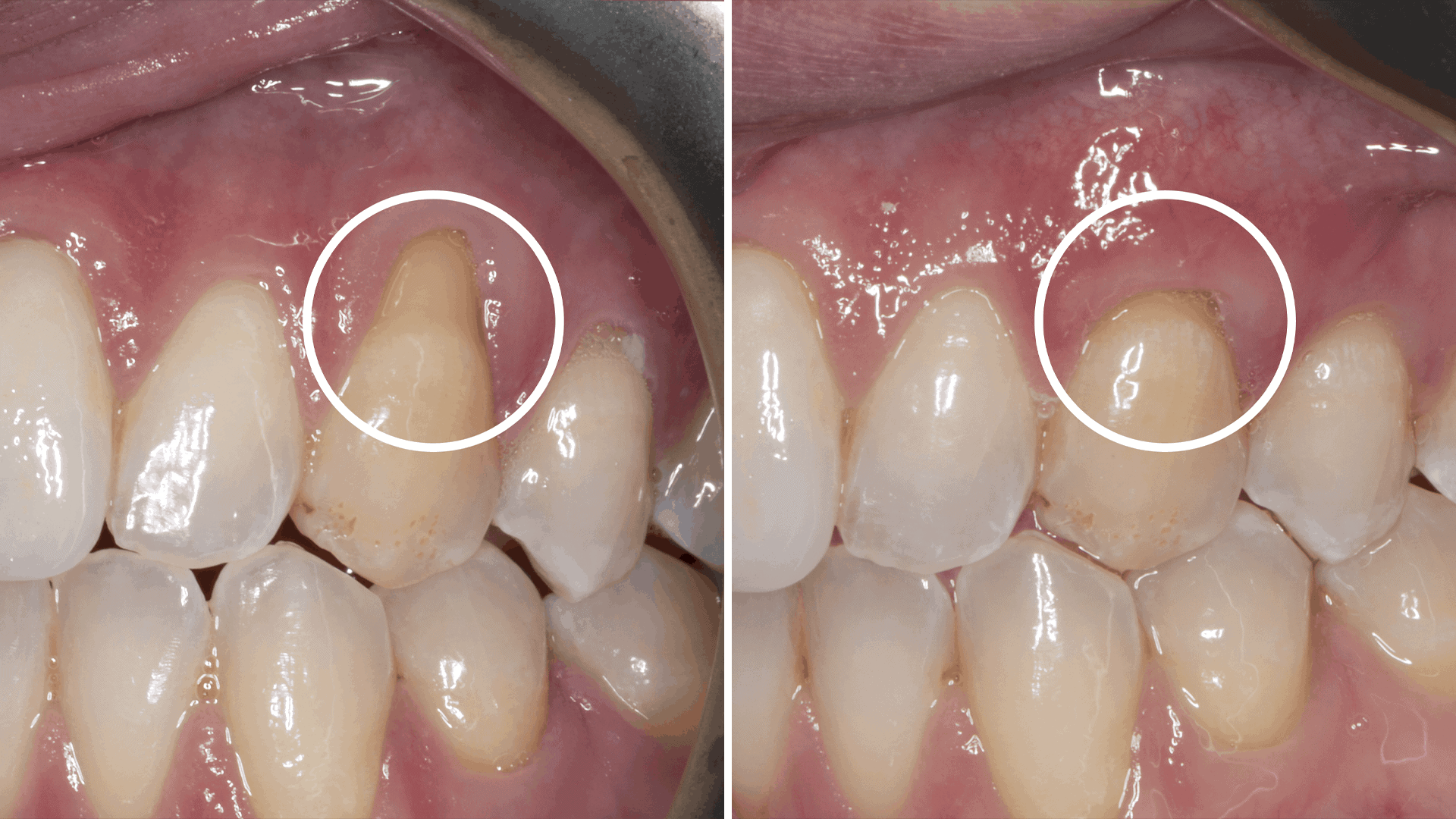 How Can You Fix Gum Recession? Stanley Dentistry