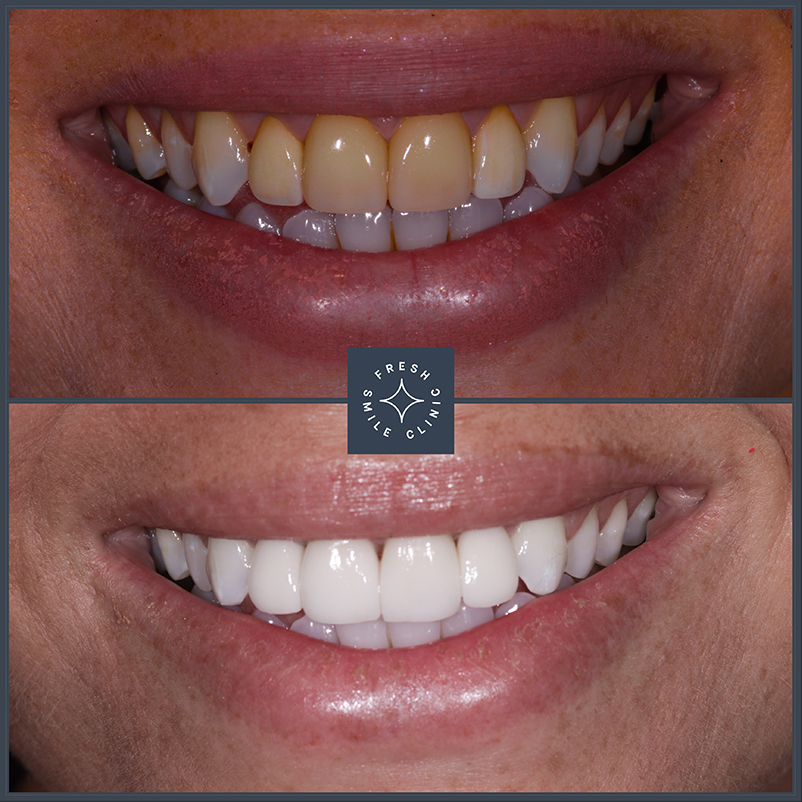 Veneers Huddersfield Fresh Smile Clinic