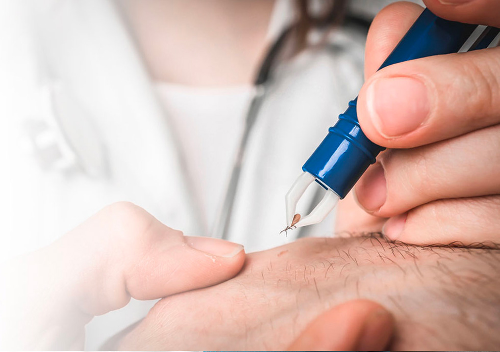 Picture of a doctor removing a tick from a patient's skin.