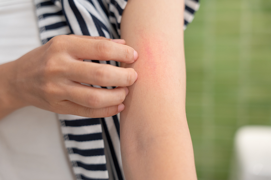 Rash and Skin Irritations Mamaroneck, NY