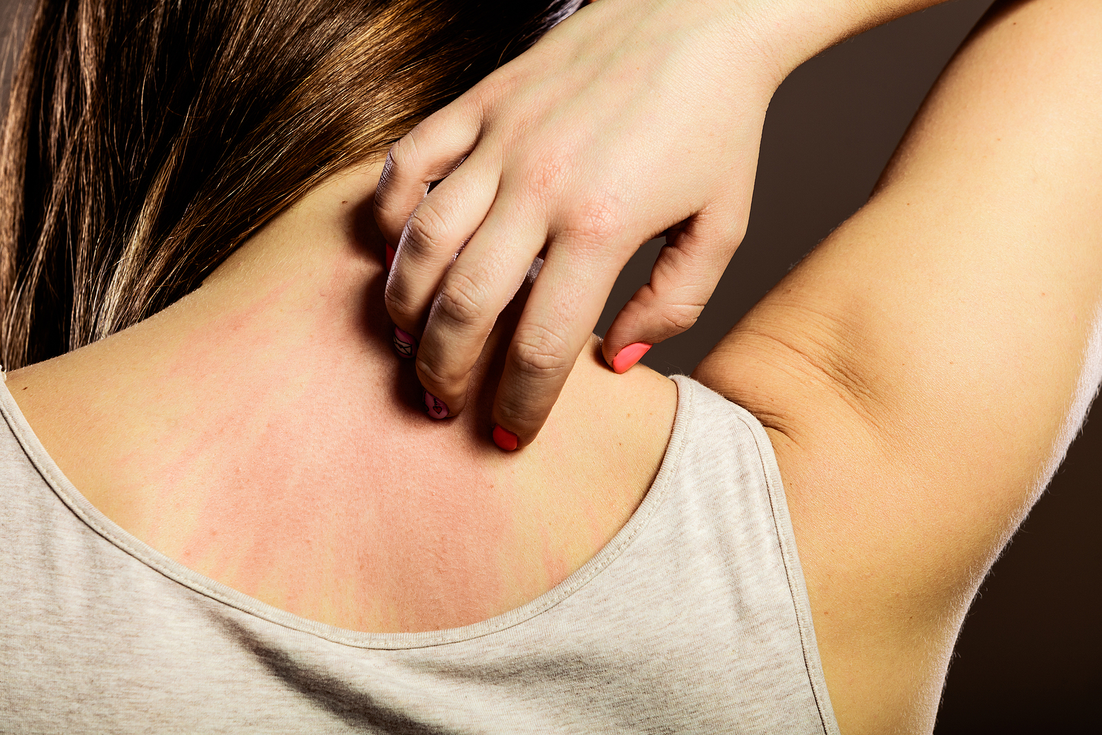Woman reaches behind her neck to scratch at her rash.
