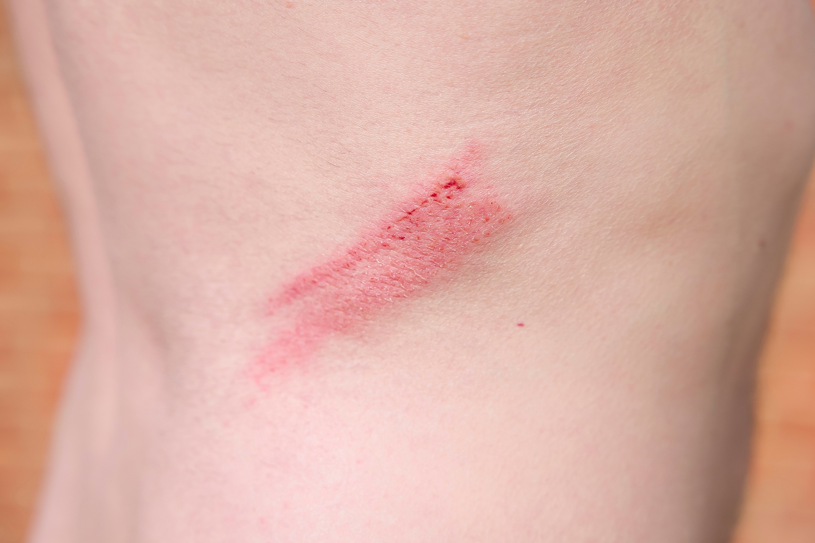 Skin abrasion on a man's back.