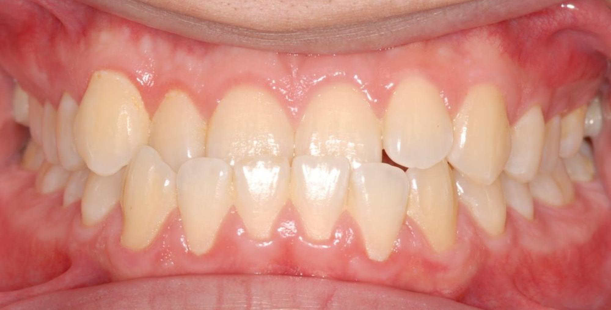 Résultat du traitement Invisalign Avant et Après Studio Smile