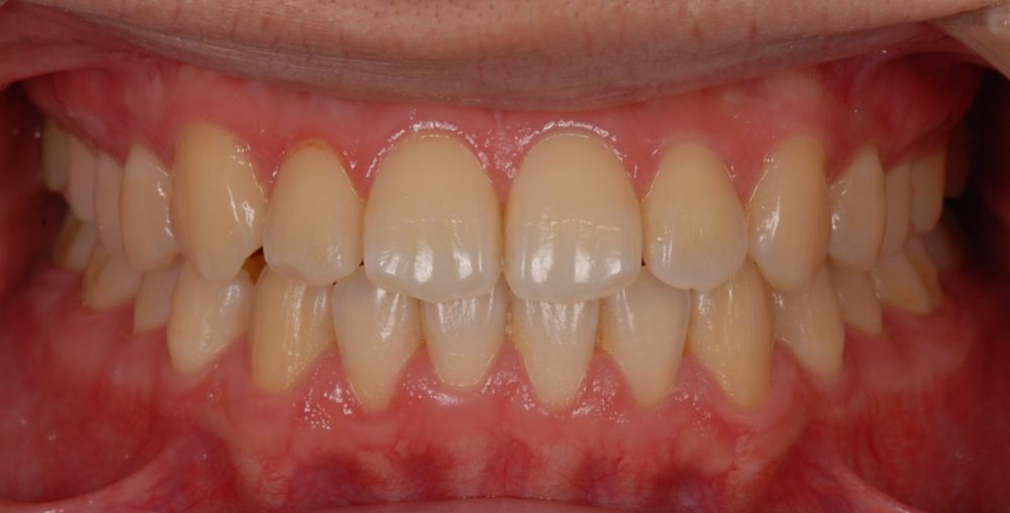 Résultat du traitement Invisalign Avant et Après Studio Smile