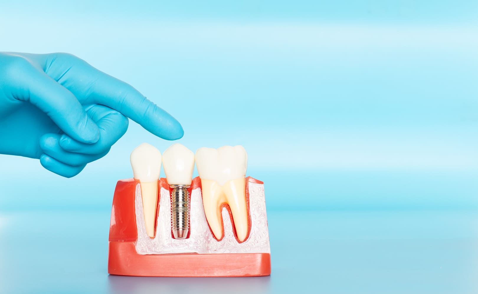 Can You Get Dental Implants After Having Dentures For Years? Smile