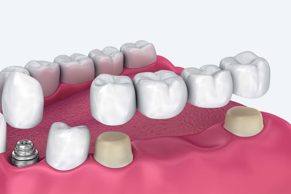 The Pros & Cons of Dental Implants and Dental Bridges
