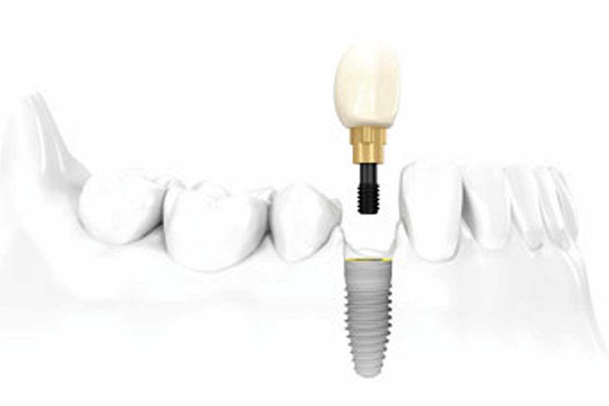 The Ultimate Guide to Dental Implants in London Bow Lane Dental