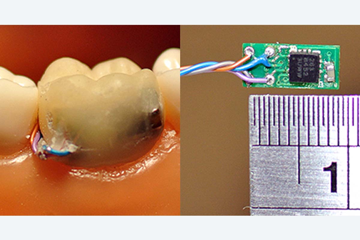 Sensors in Your Teeth, Is This the Future | Bow Lane Dental Group