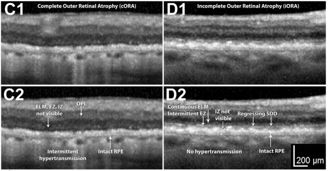 Comprehensive Assessment of Geographic Atrophy - Optical Coherence ...