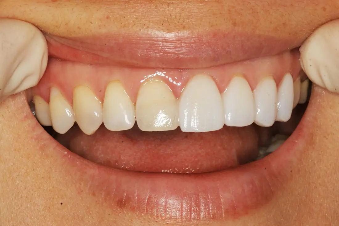 NoPrep Veneers in Atlanta Atlanta Dental Spa