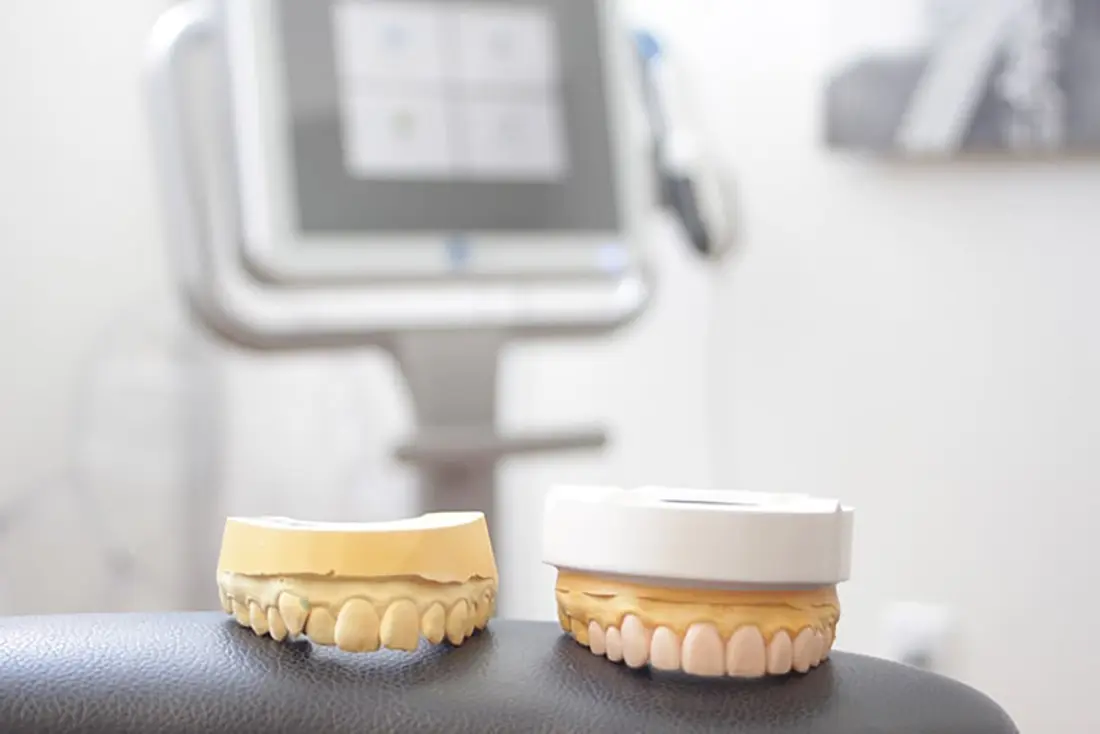 NoPrep Veneers in Atlanta Atlanta Dental Spa