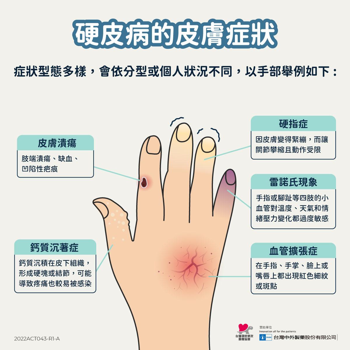 認識硬殼 - 硬皮病的症狀