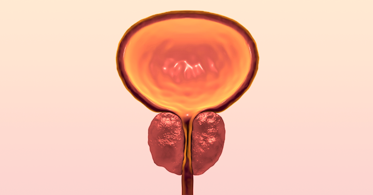 Benign Prostatic Hyperplasia Bph Symptoms Diagnosis Treatment Benign Prostatic Hyperplasia Bph Symptoms Diagnosis Treatment