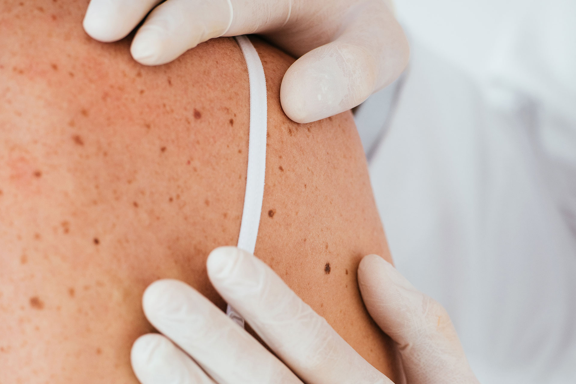 Common types of moles