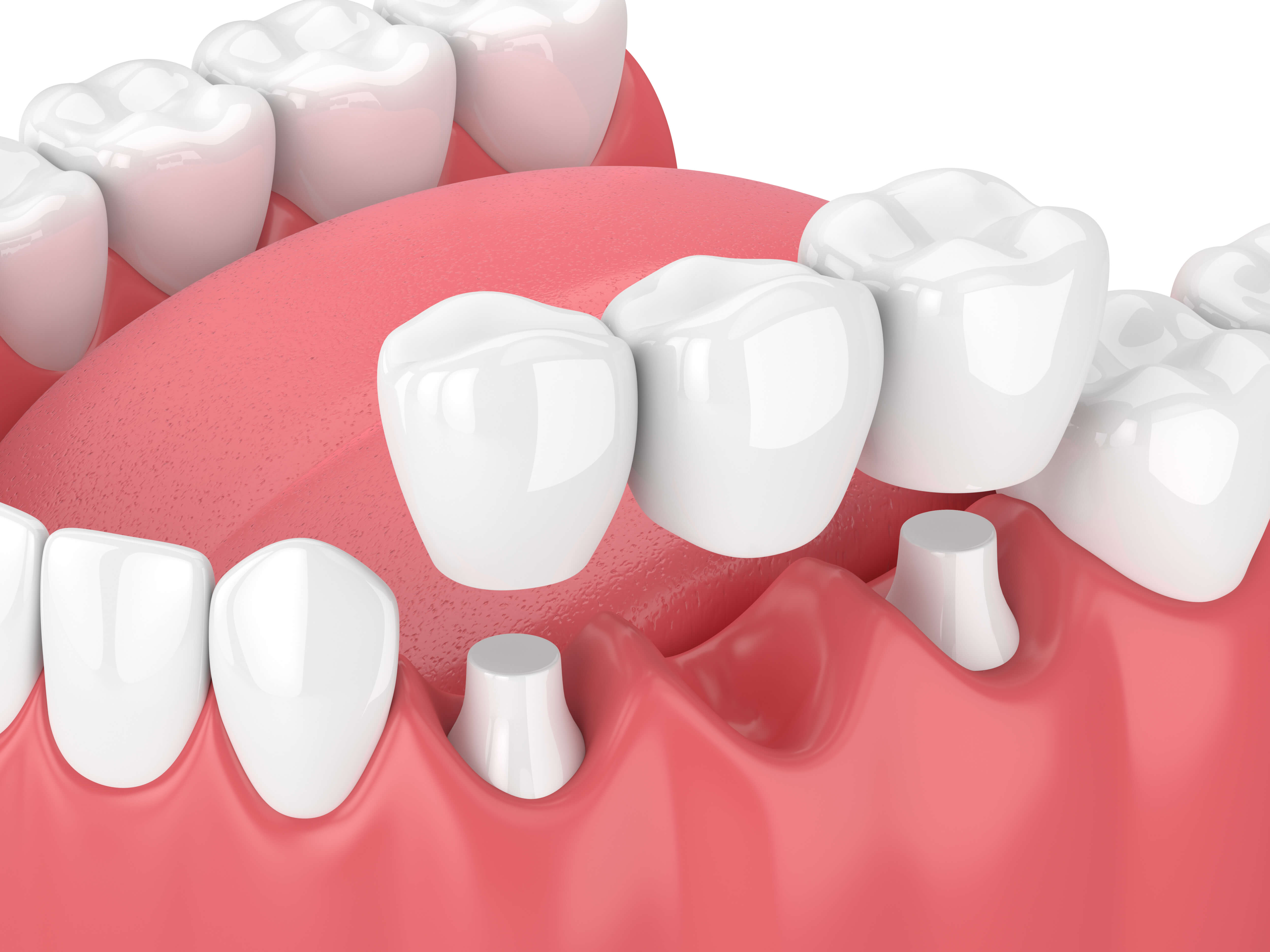 Dental Bridges Service Everson Dental