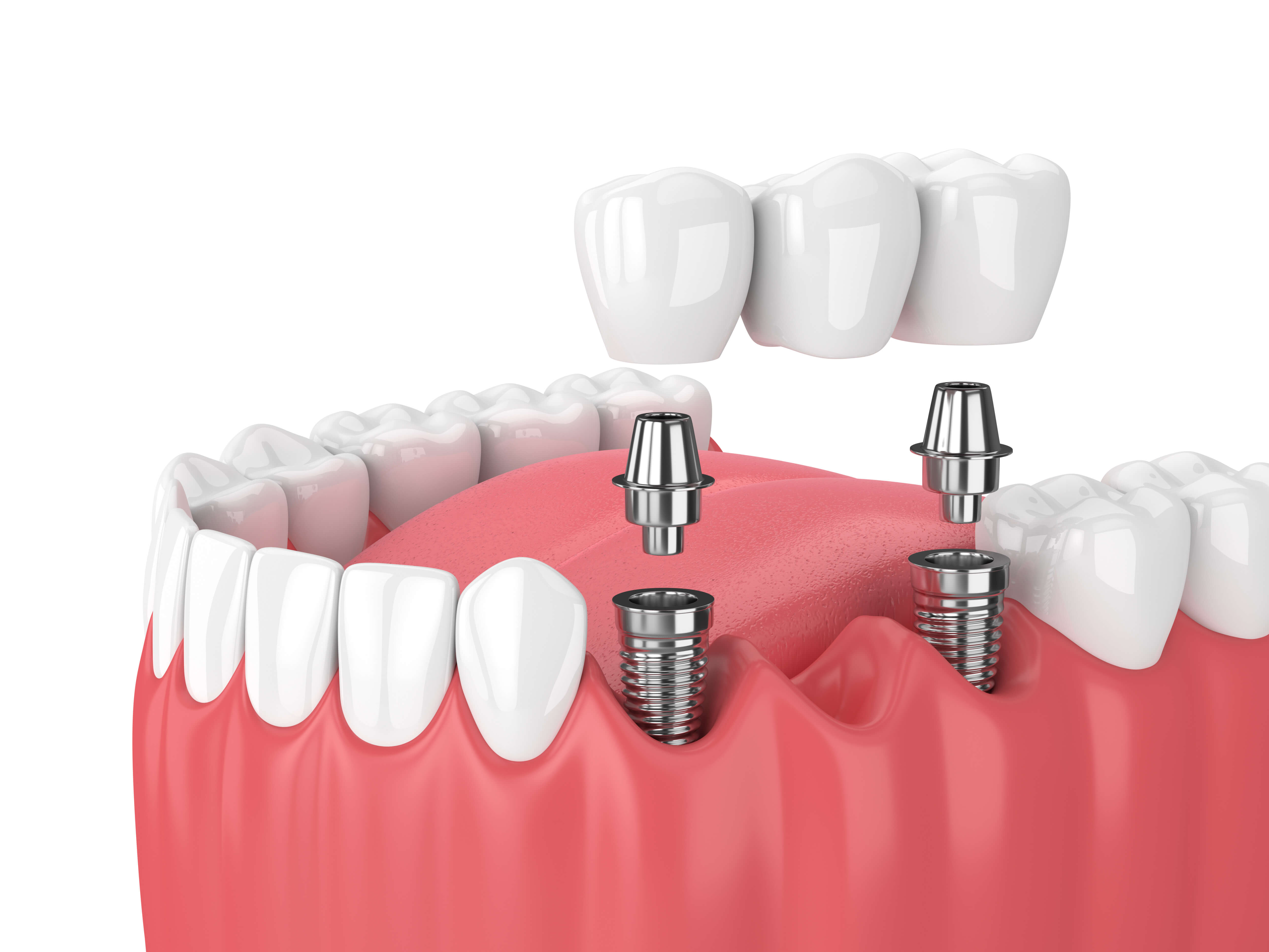 Dental Implants Get a NaturalLooking Smile at Everson Dental