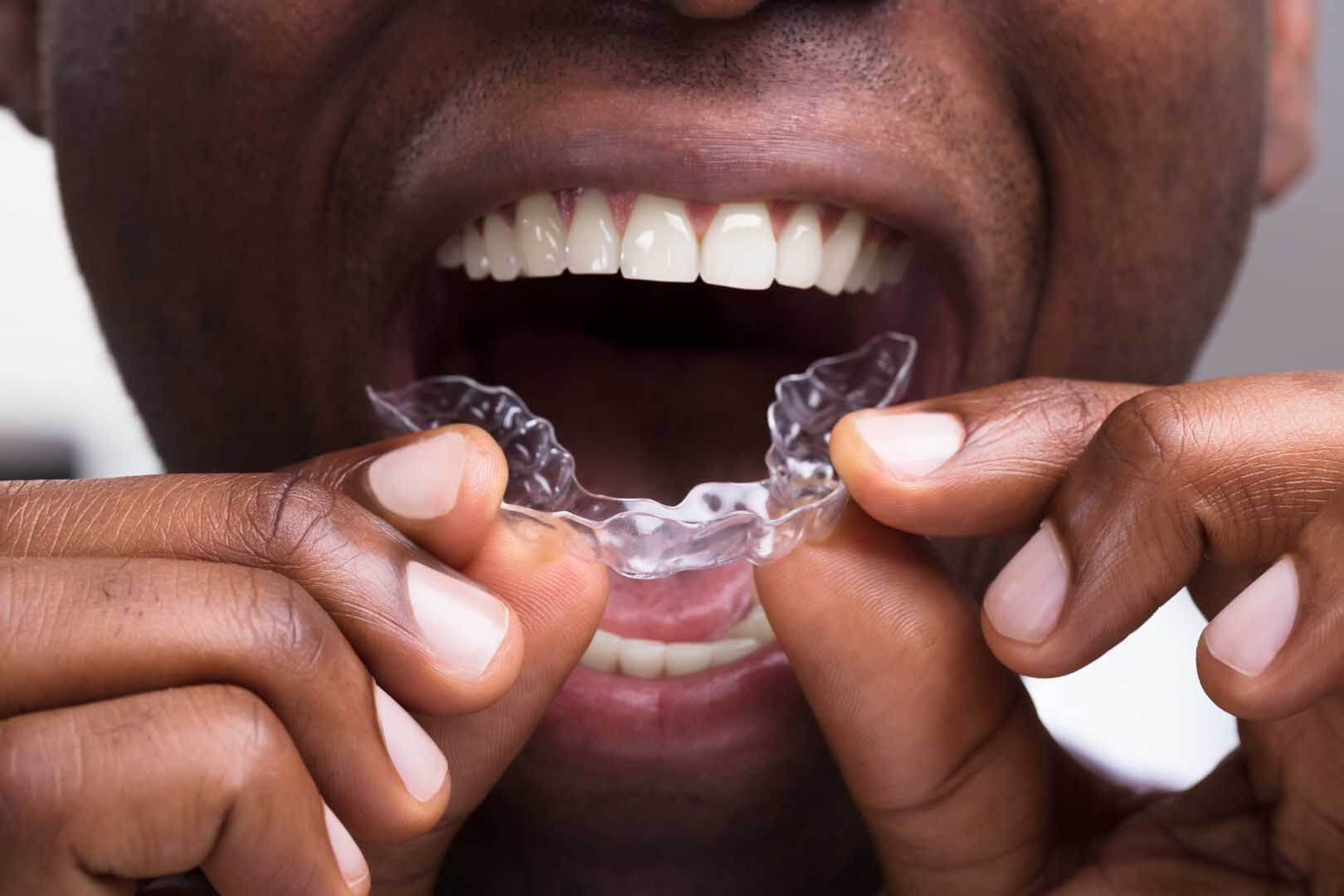 Occlusal & Sports Guards from Everson Dental Protect Your Smile