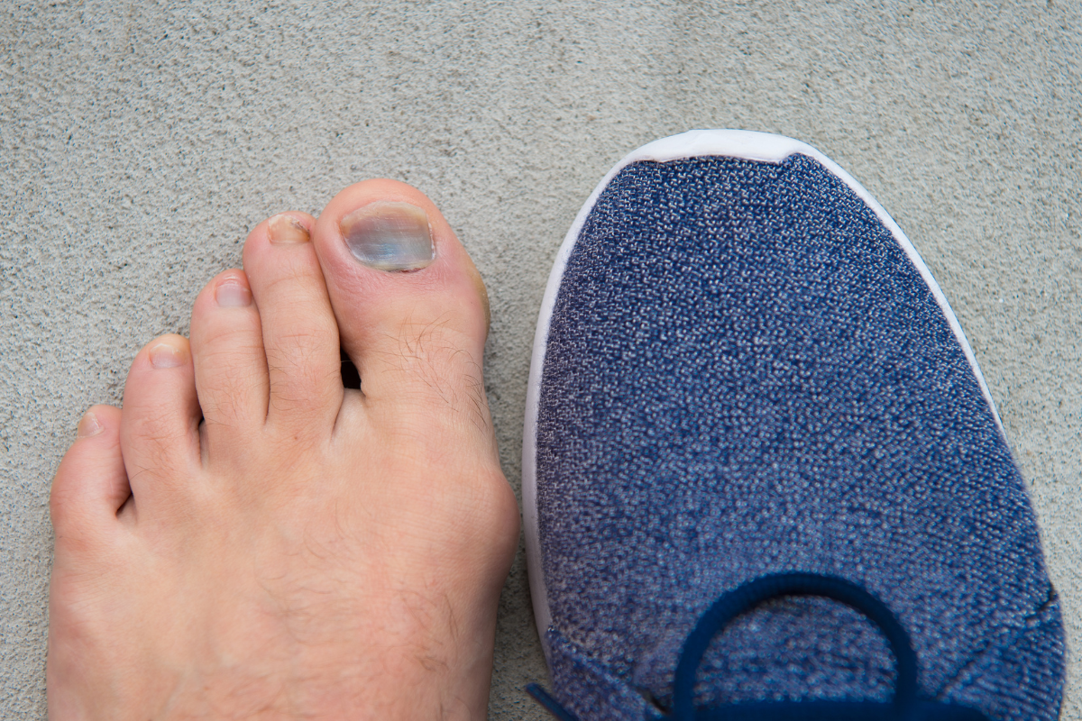 Toenail Removal Aftercare StepbyStep Guide for Speedy Recovery