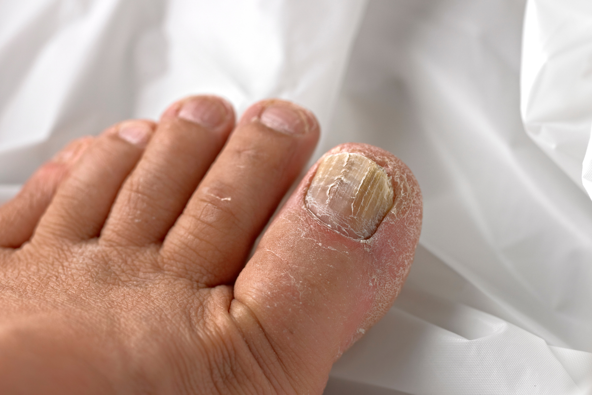Why Are My Toenails Growing Sideways? Find Out the Surprising Reasons