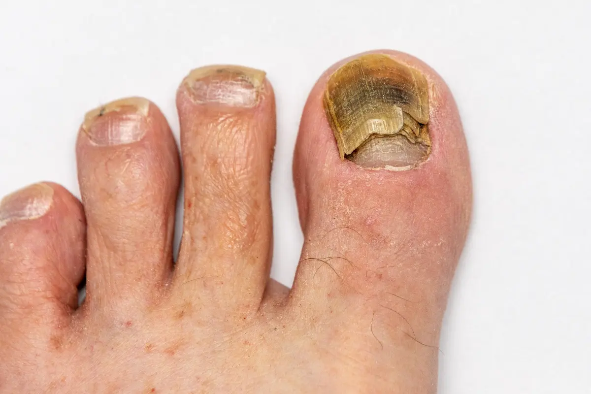 Explainer why do we get fungal nail infections and how can we
