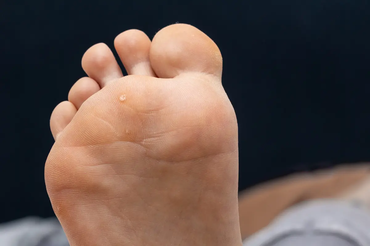 Why Are the Bottom of My Feet Yellow? Understanding the Causes and