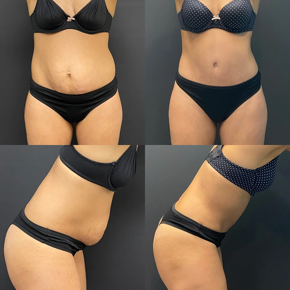 Plastic Surgery Before and After Photos Amelia Aesthetics Raleigh