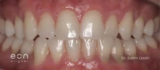 Clear Aligners For Crowded Teeth: Why They Are An Effective Treatment