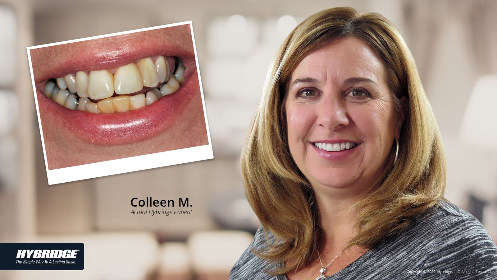 Hybridge Full Arch Smile Gallery