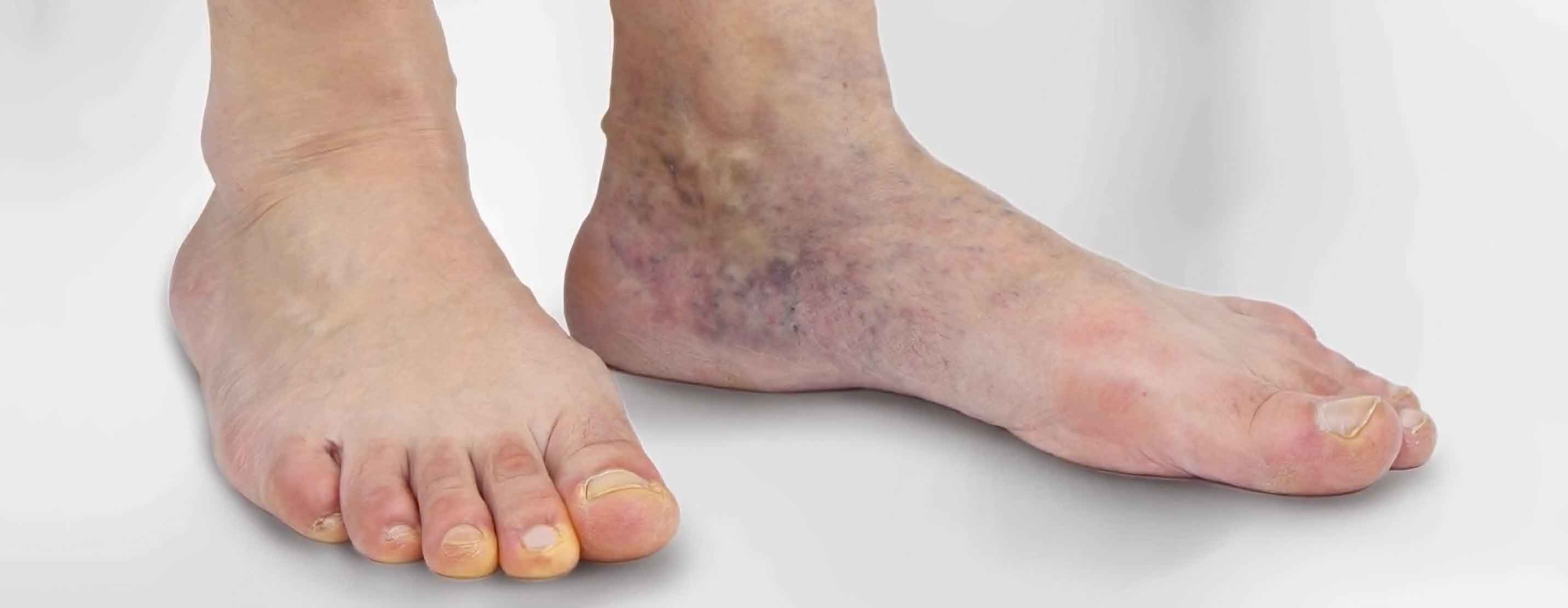 Varicose Vein Treatment showing a foot with symptoms