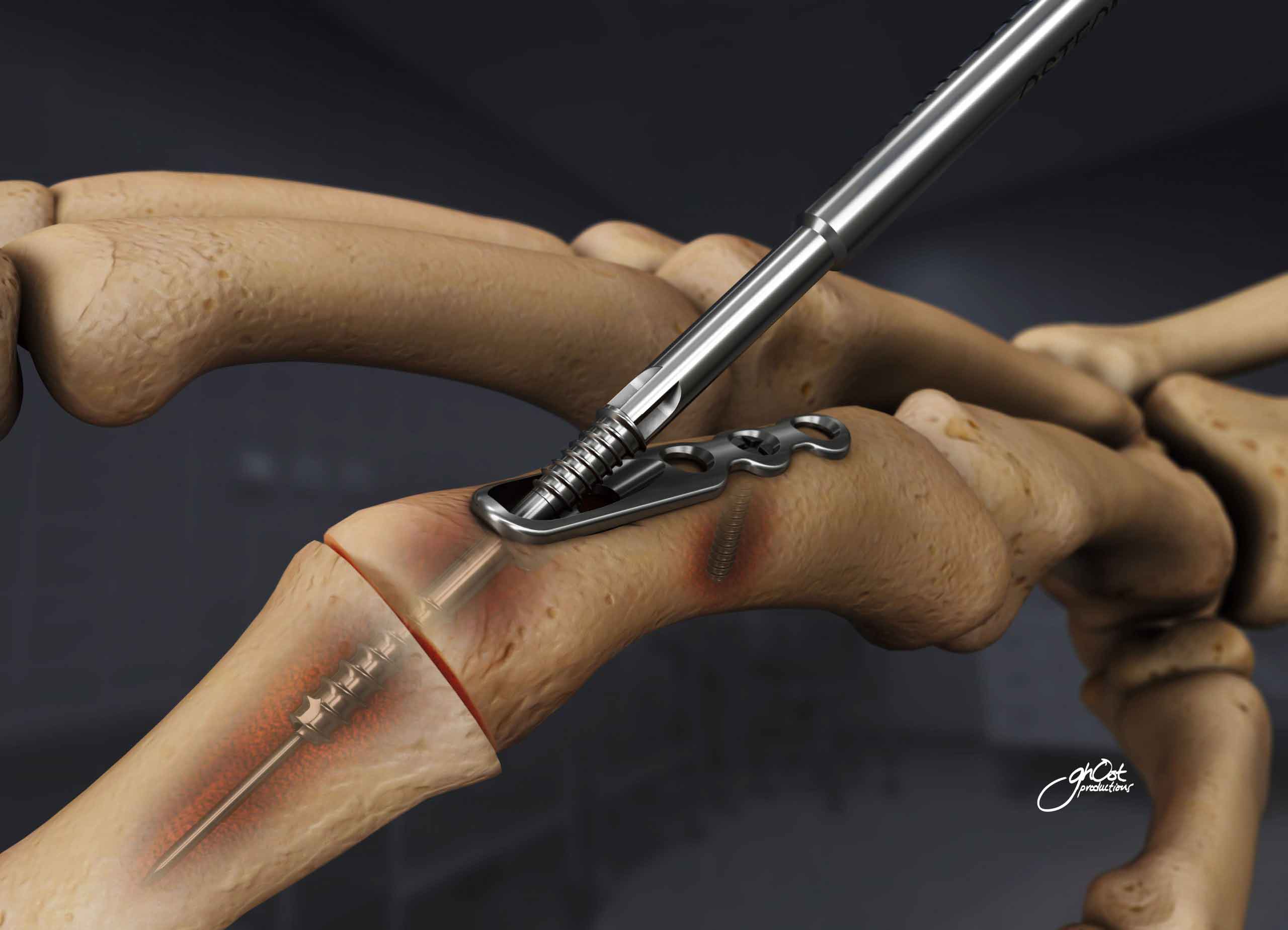 Osteomed Fusion Joint Fixation System Ghost Medical Images