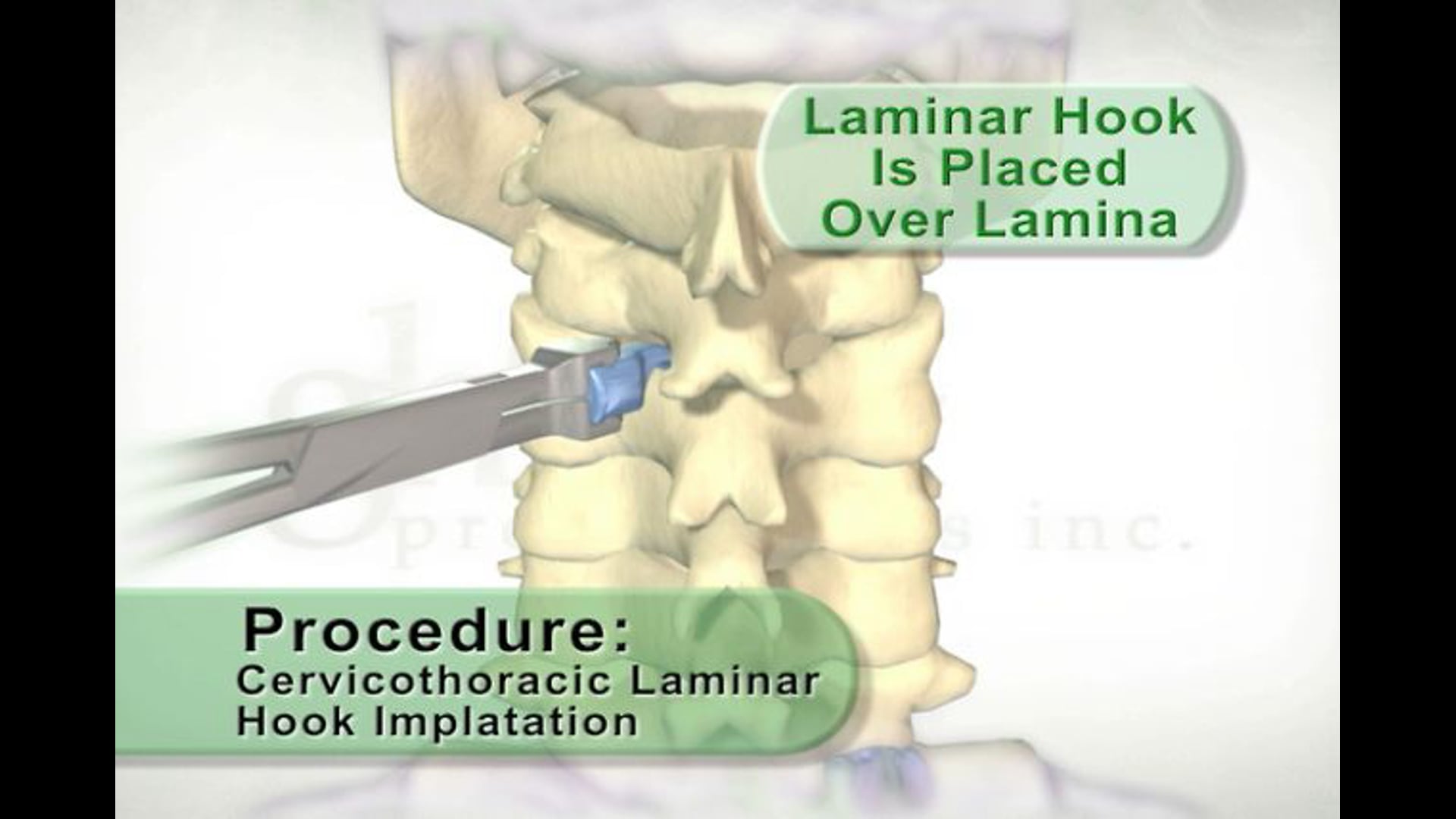 Procedure Cervicothoracic Hook Implantation Video