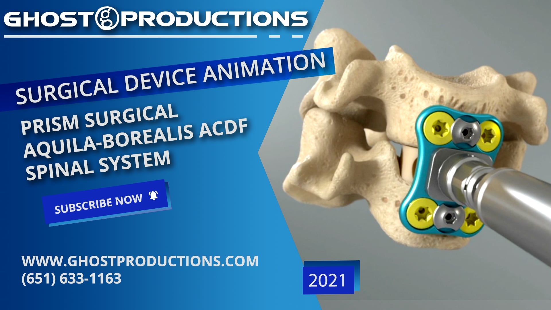 Prism Surgical - AQUILA-BOREALIS ACDF Spinal System | Video