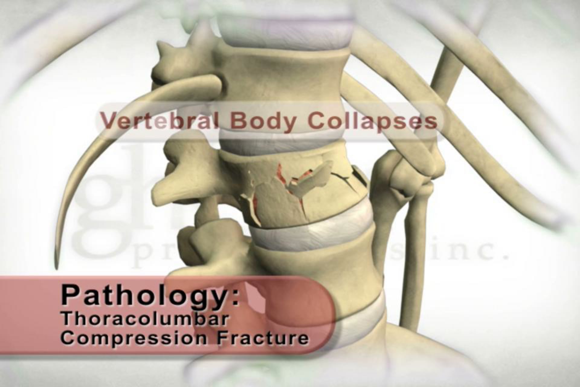 Thoracolumbar Compression Fracture Video