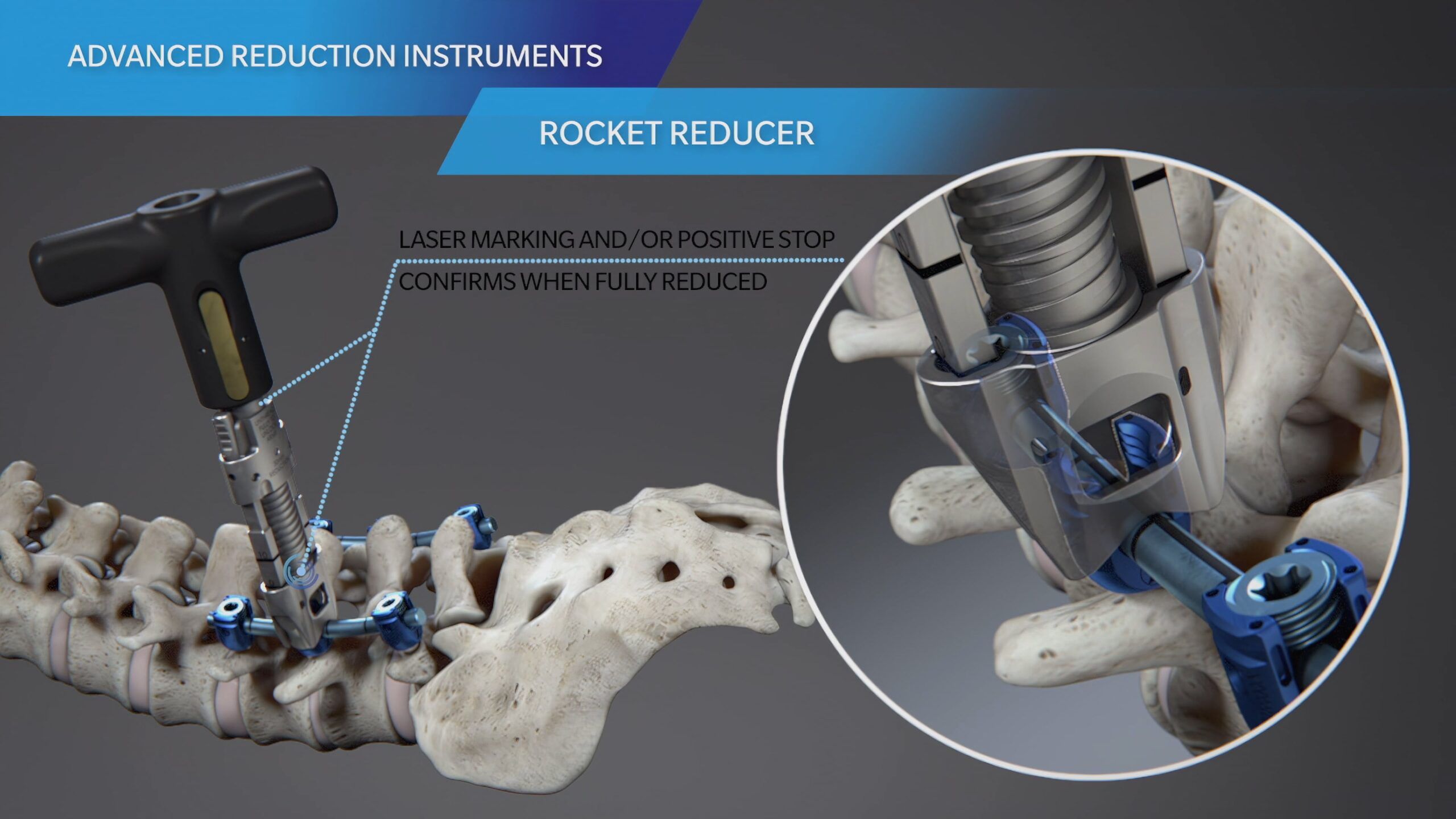 Zimmer Biomet Vital™ Spinal Fixation System Degenerative Video