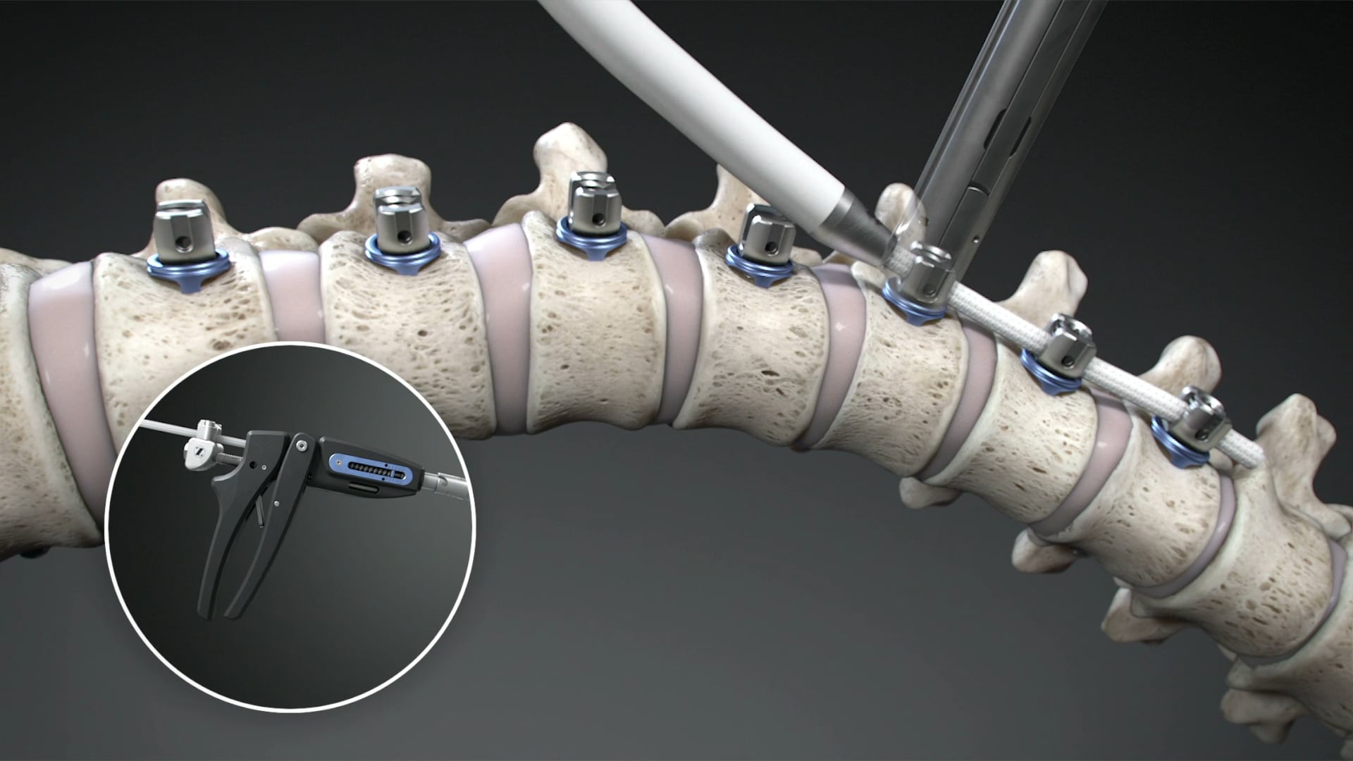 Ghost Productions Zimmer Biomet Tether Surgical Technique Video