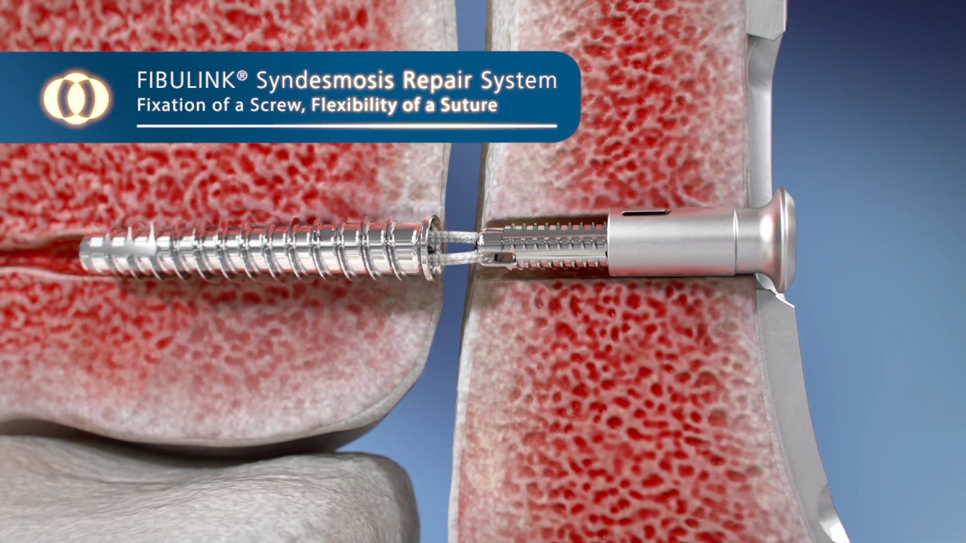 Ghost Productions DePuy FIBULINK® Syndesmosis Repair System Video