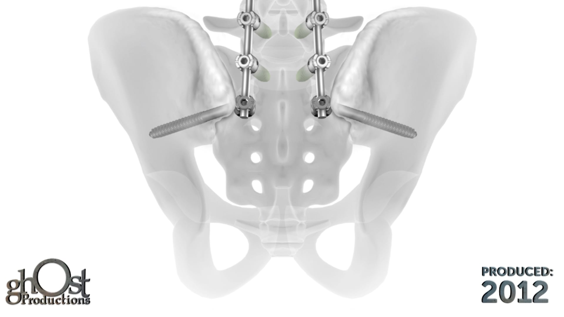Depuy Pelvis Video