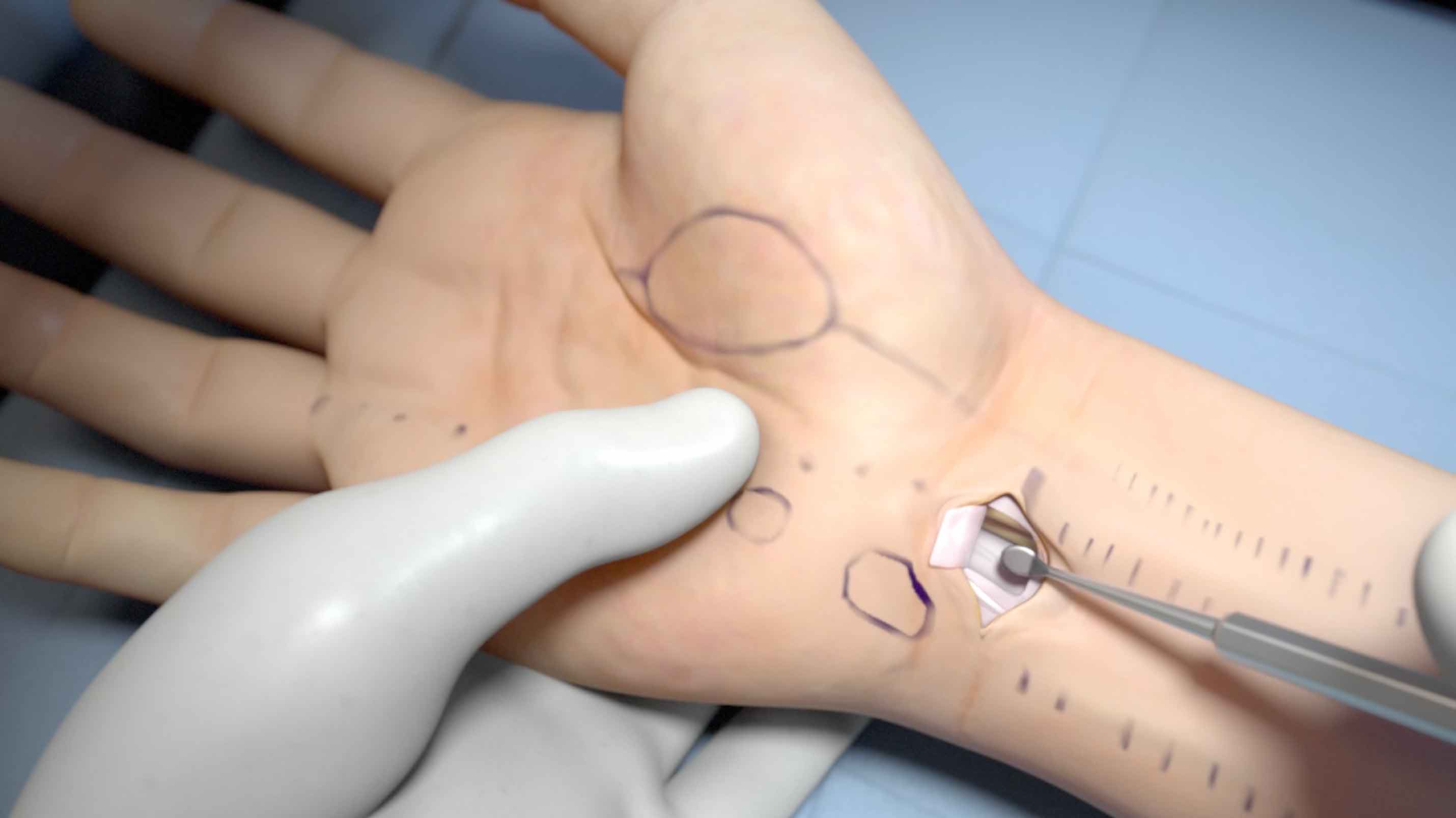 SmartRelease Carpal Tunnel Release System Image smartrelease-carpal-tunnel-release-system-image