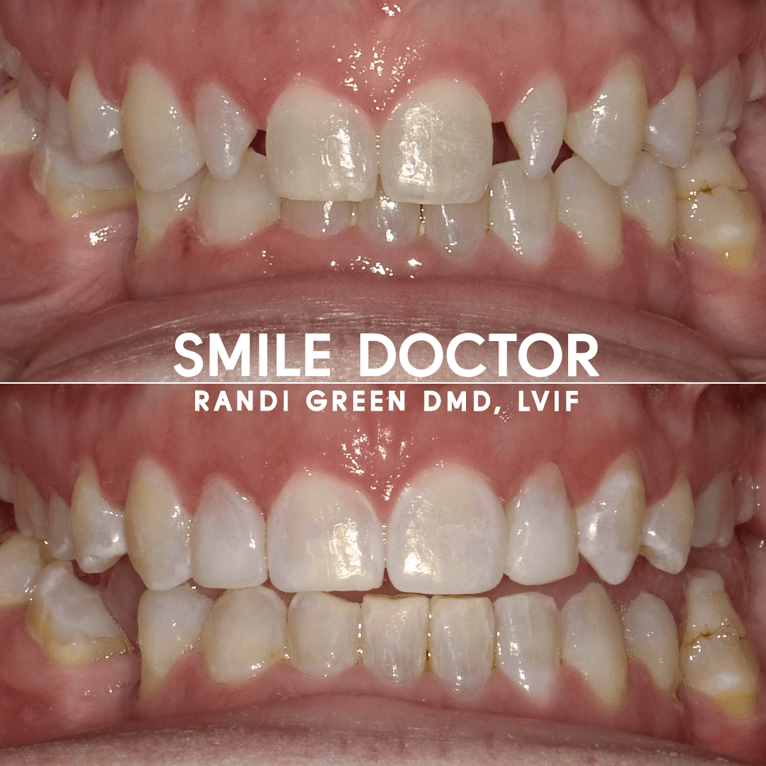 Dental Bonding Springfield Smile Doctor Dr. Randi Green