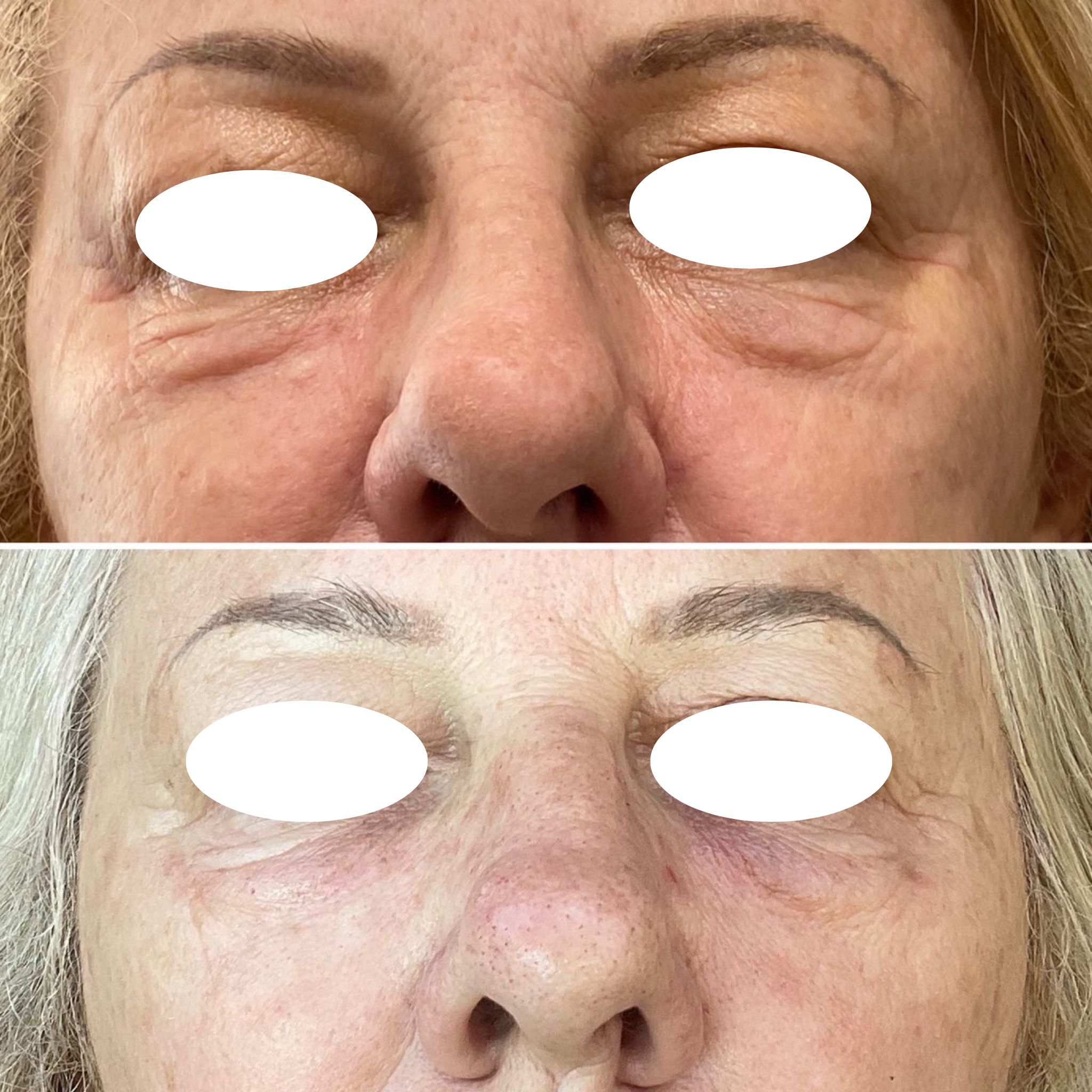 Under Eye Bags Festoons GMC Cosmedical