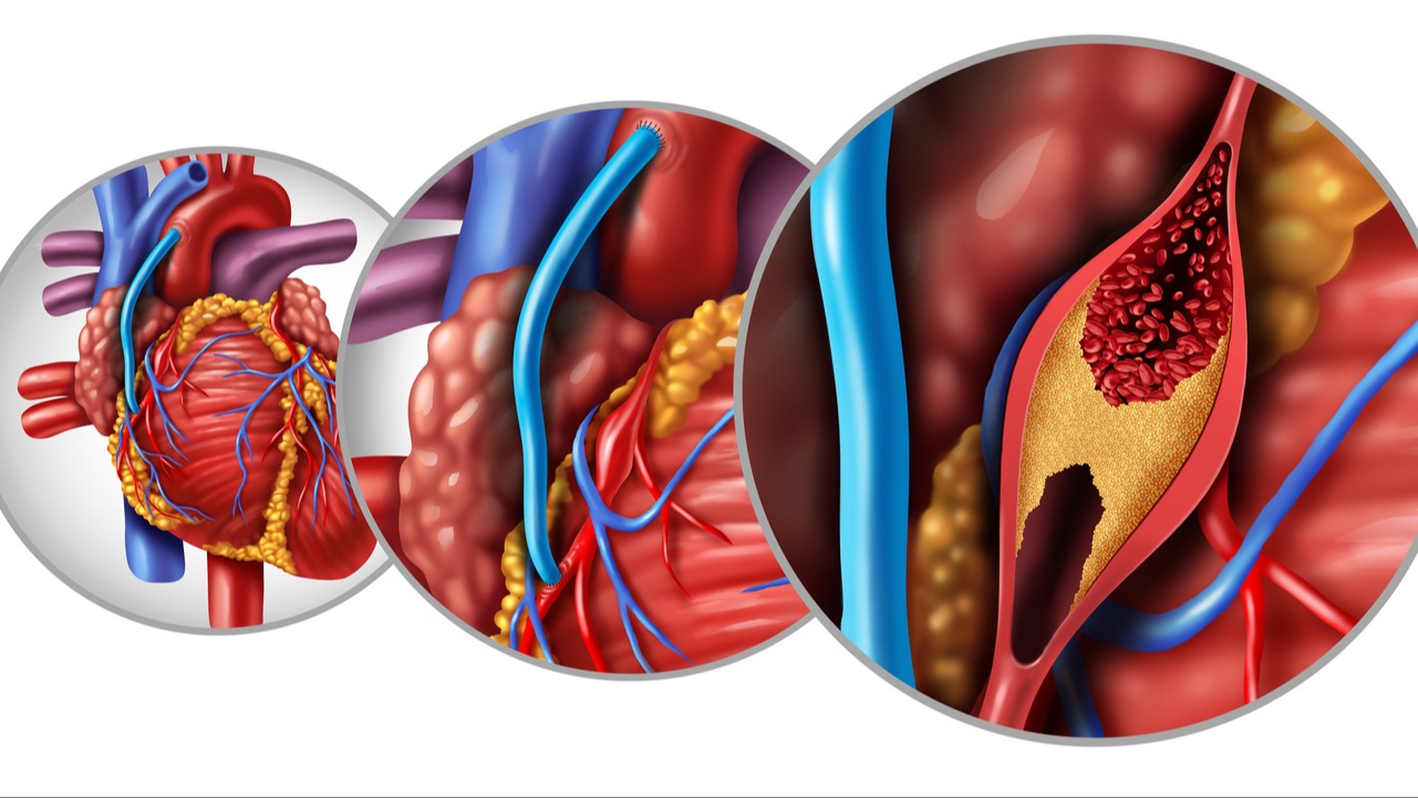 Definition Of Coronary Artery Bypass Graft Cabg Definition Of Coronary Artery Bypass Graft Cabg