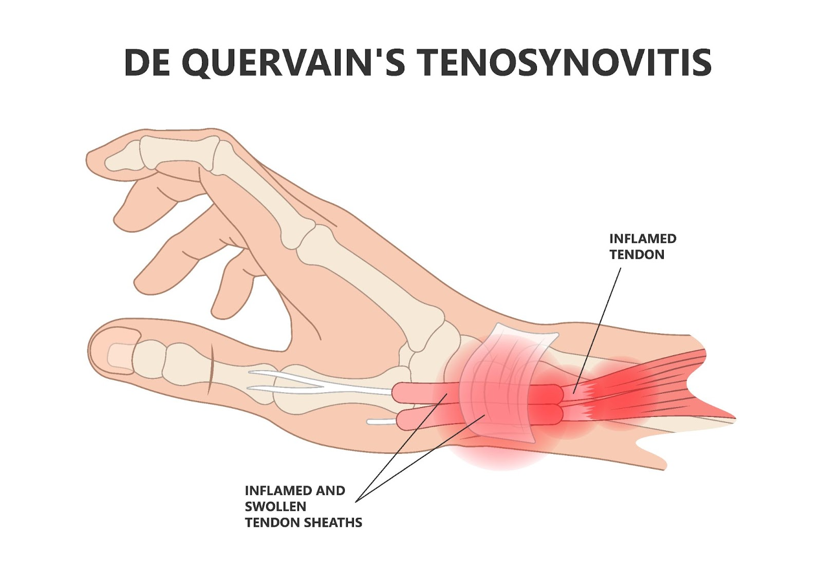 De Quervain’s Tenosynovitis