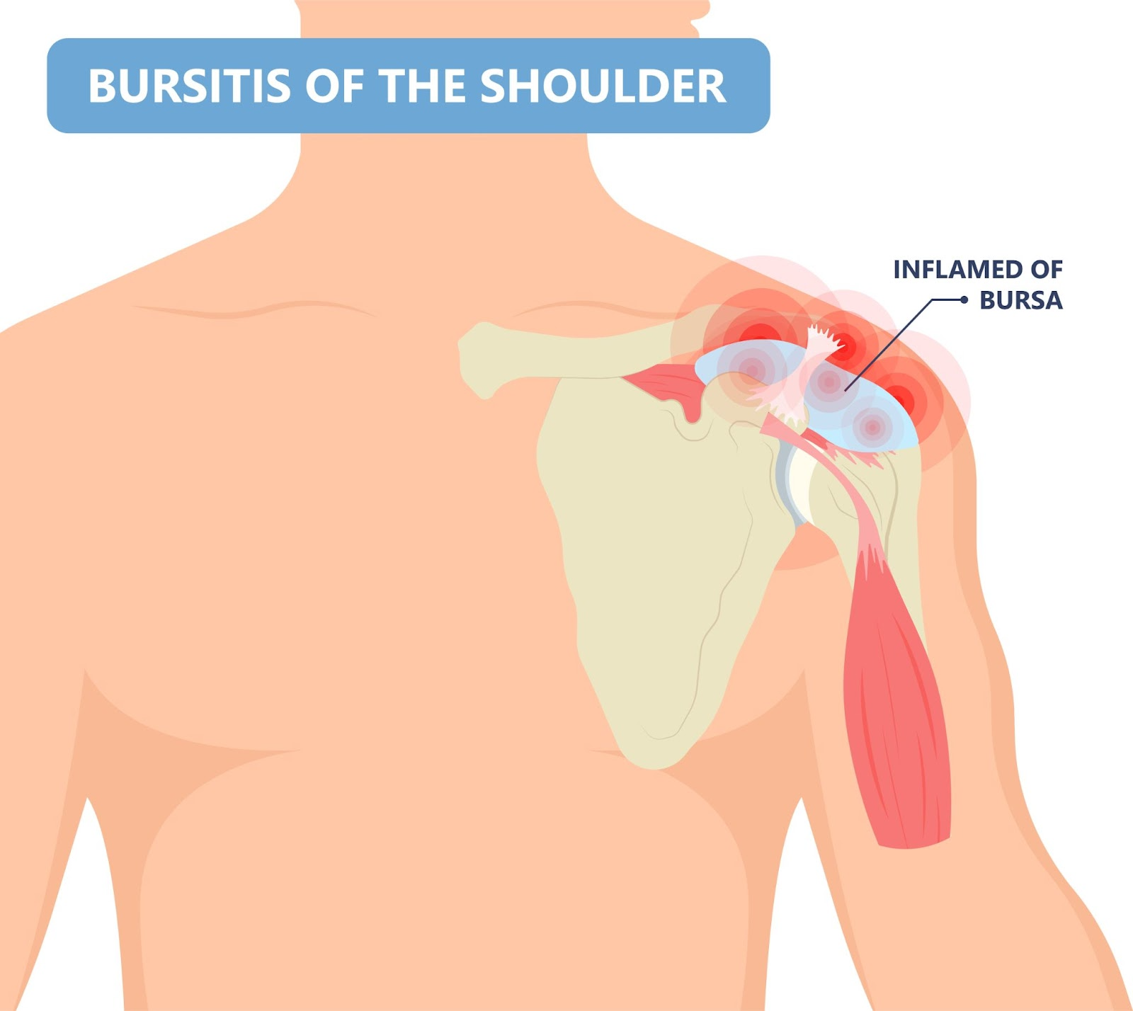 Shoulder Bursitis