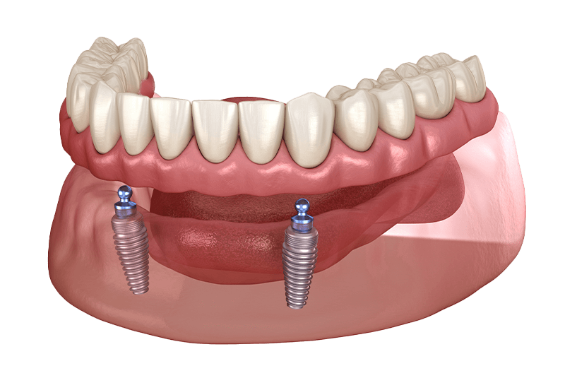 Implant Supported Dentures in Houston, TX Dr. Friedberg