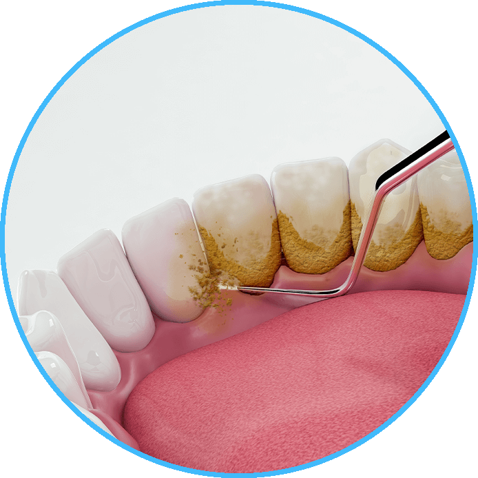 Periodontal Maintenance Houston, TX Friedberg & Associates