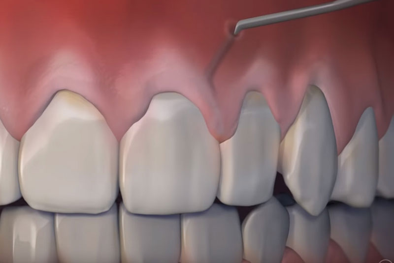 Pinhole Surgical Technique | Houston, TX | Periodontist