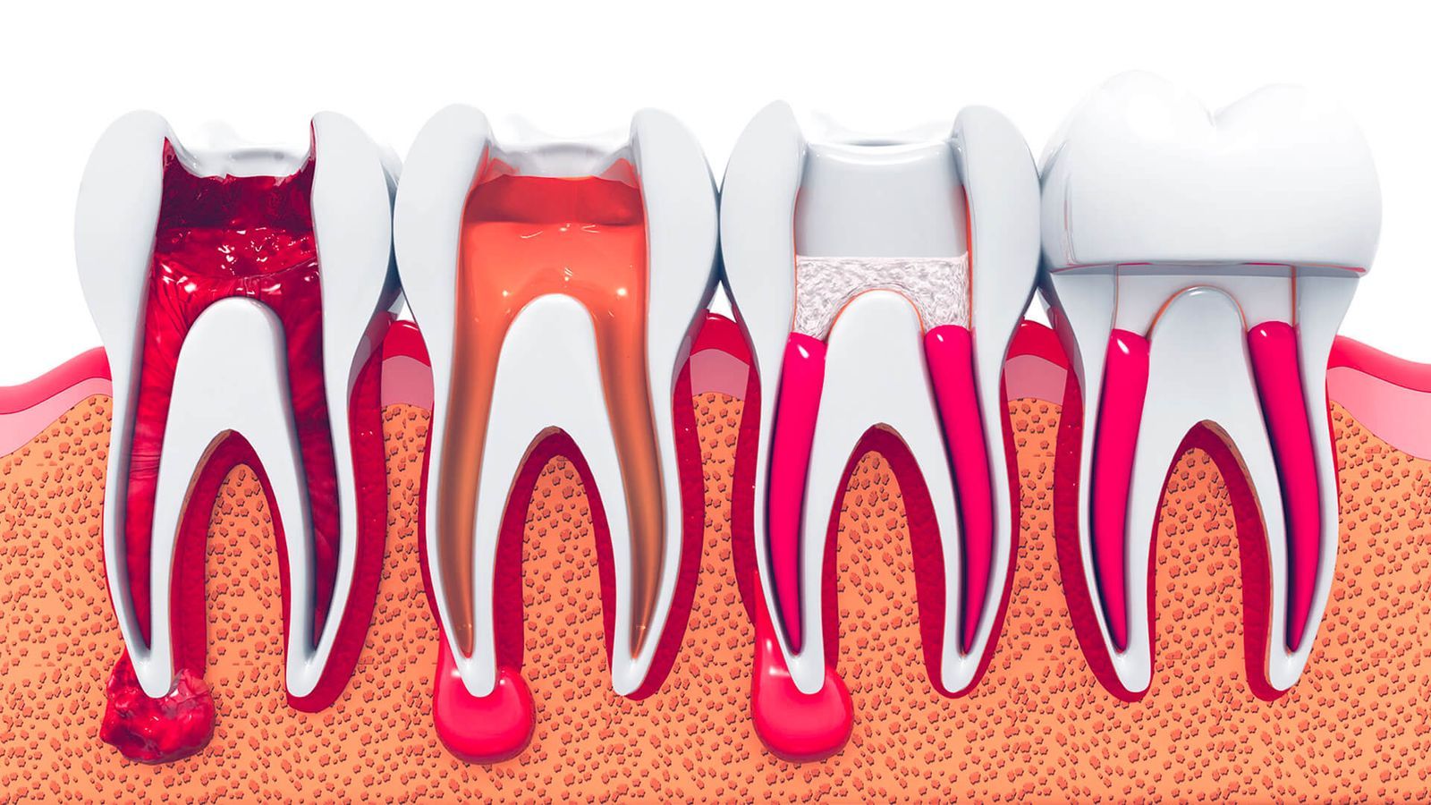 Endodontics Houston TX Dr. Friedberg & Associates