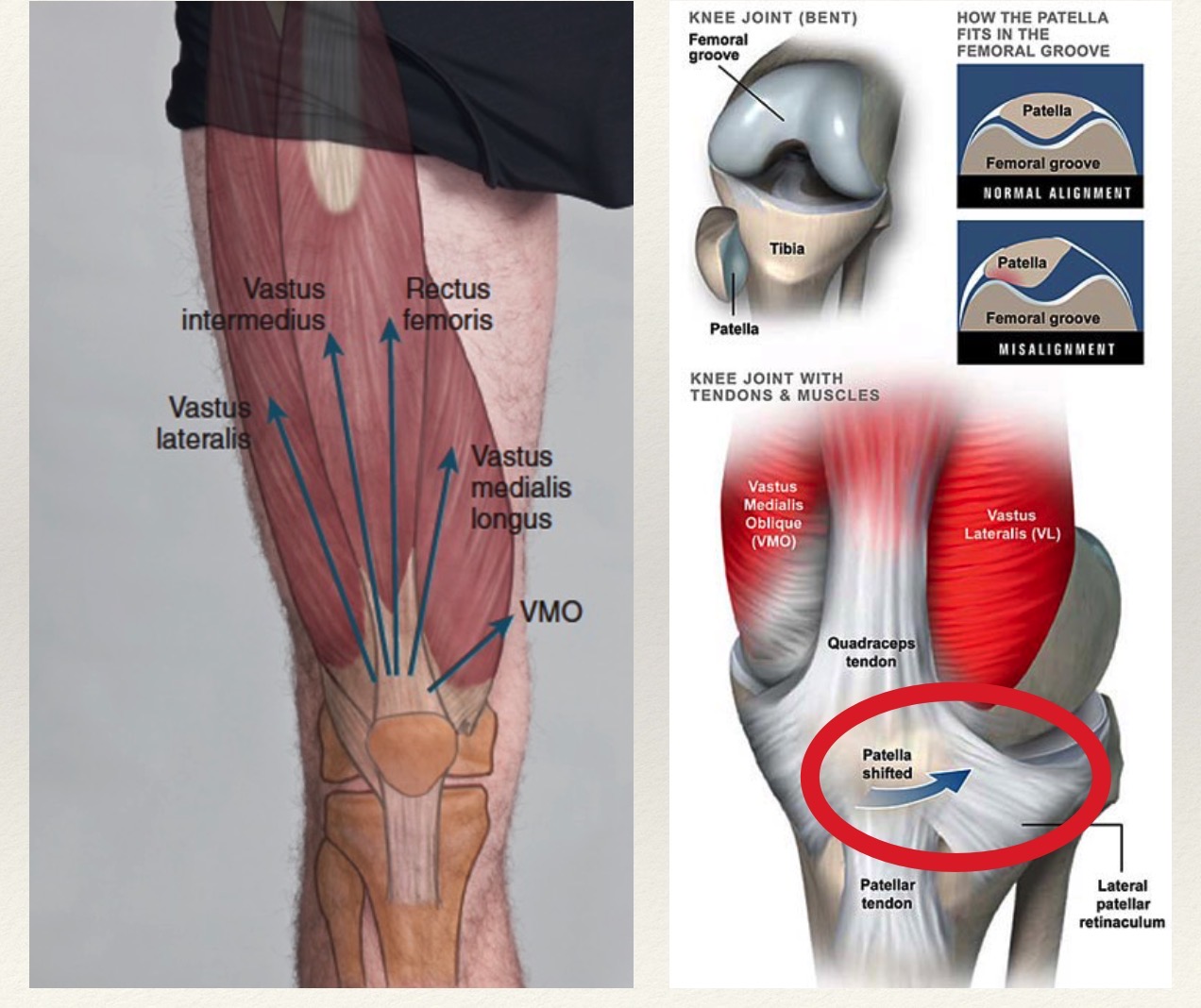 Vmo Chondromalacia Patella - Where Pain Referral Meets Function