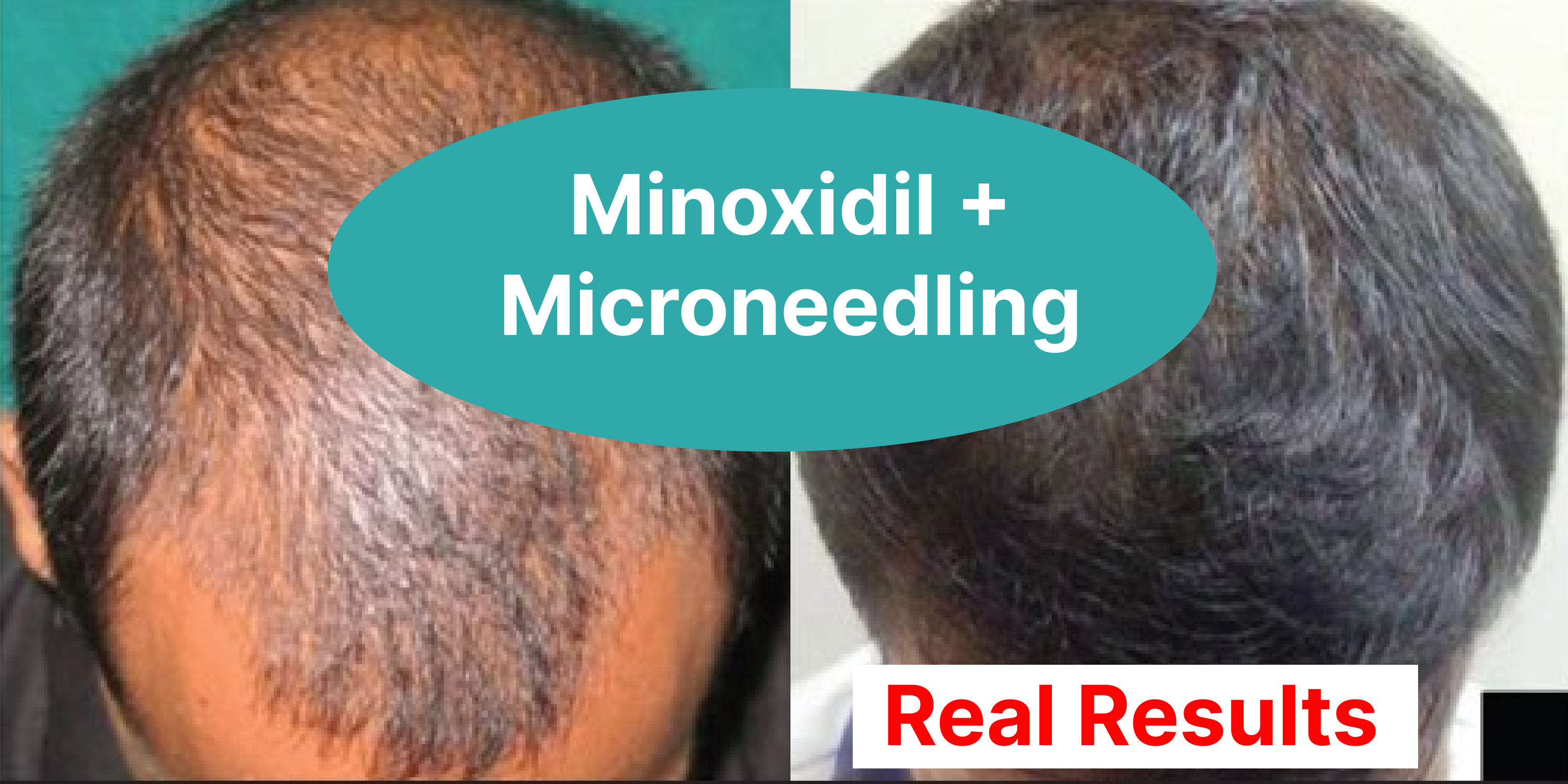 Minoxidil Anxiety - 4nupofm