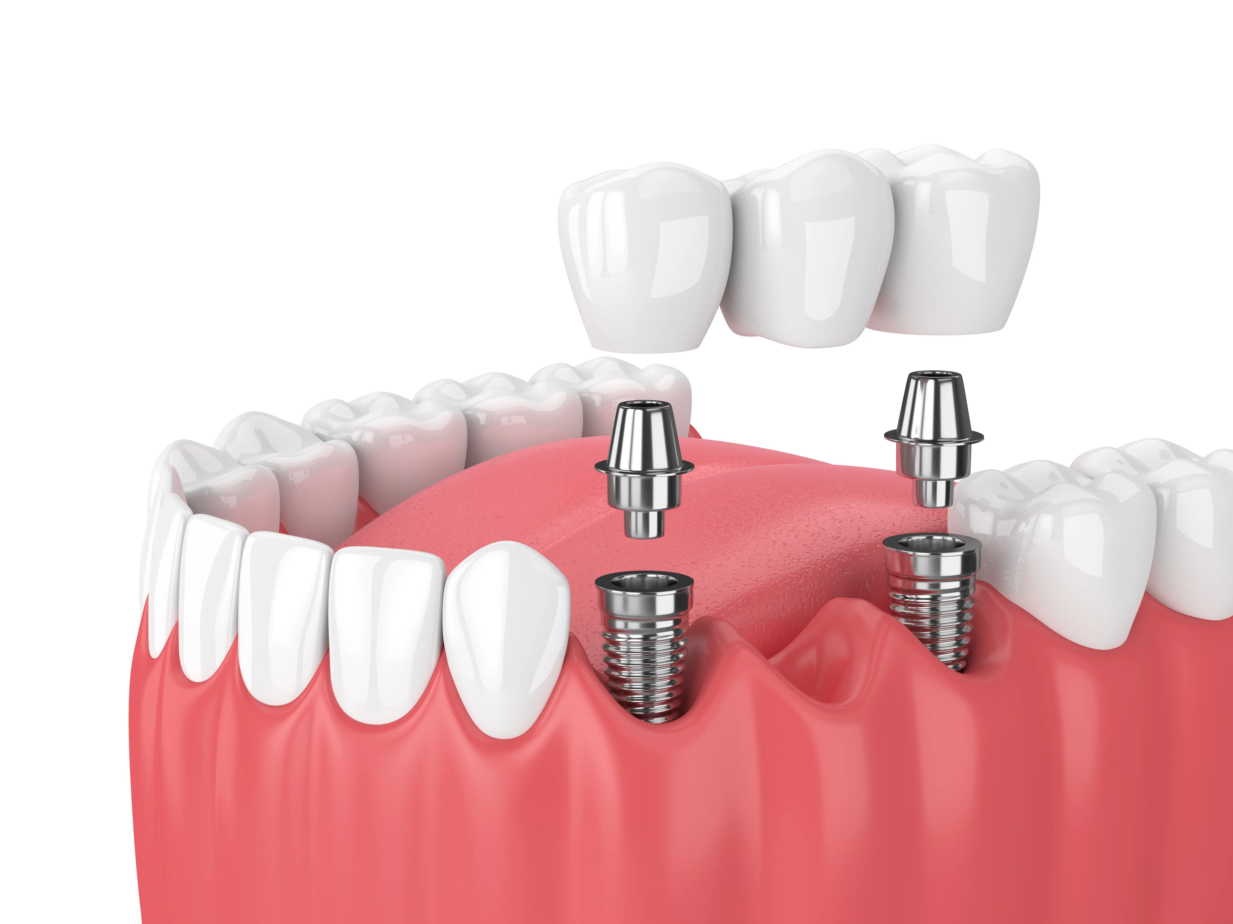 Hybridge Dental Implants Chips Dental Associates